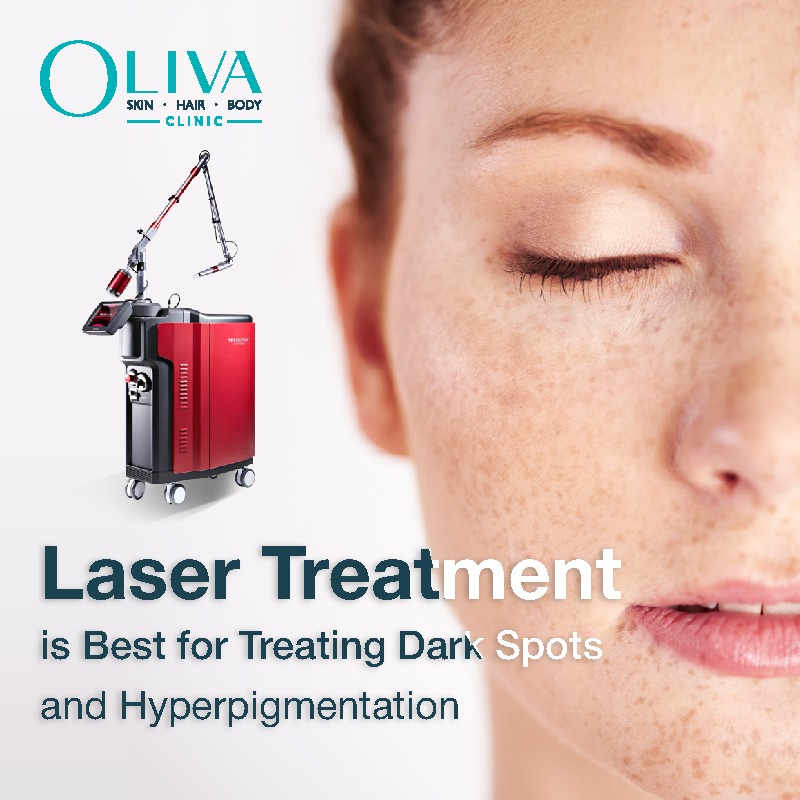 laser treatment for dark spots