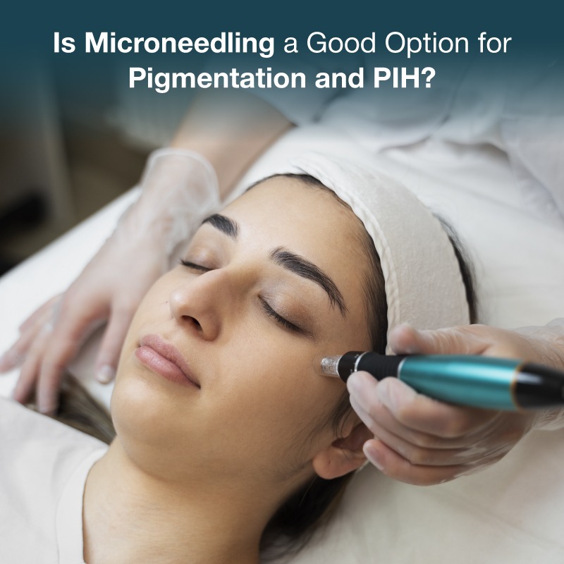 microneedling for pigmentation