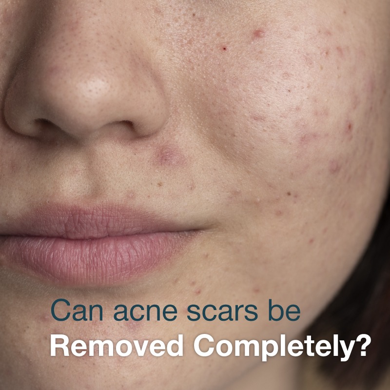 Can acne scars be removed completely
