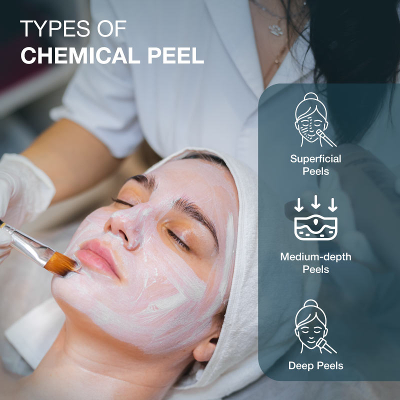types of chemical peel