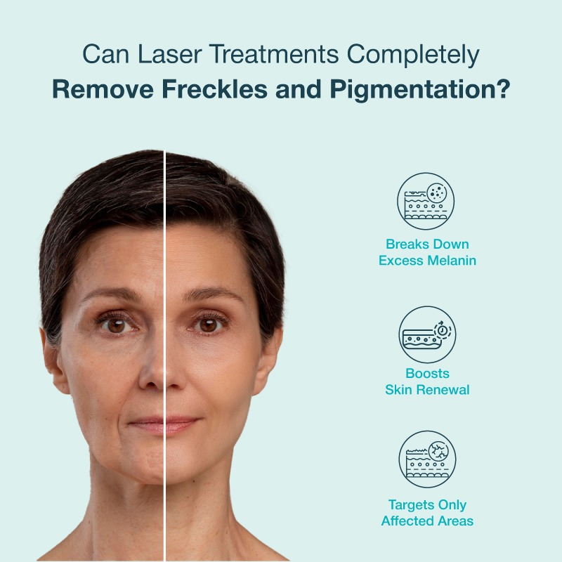 laser treatments remove frickles and pigmentation