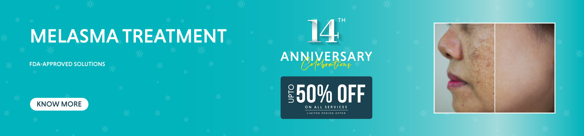 melasma treatment banner