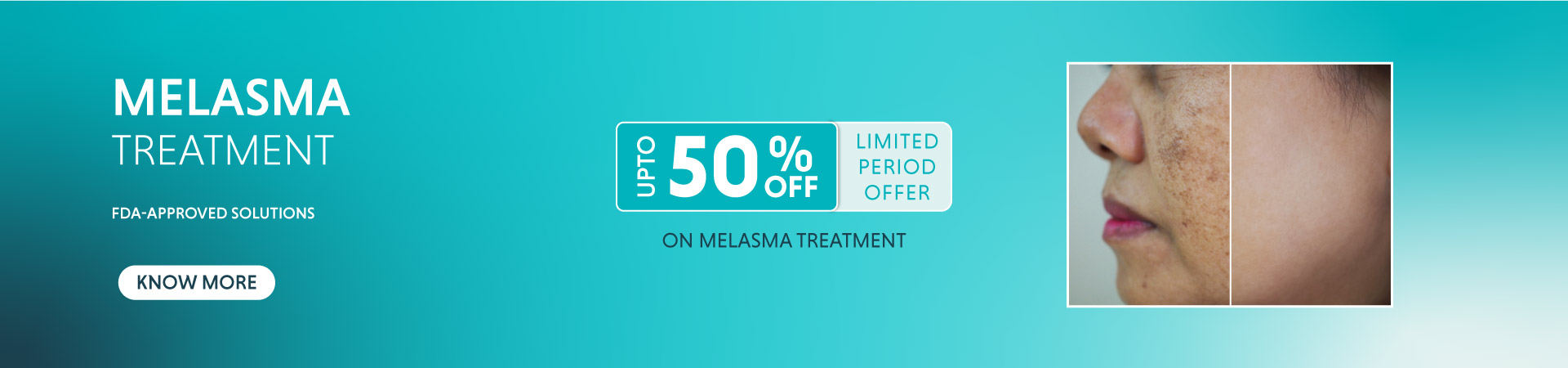 melasma treatment banner