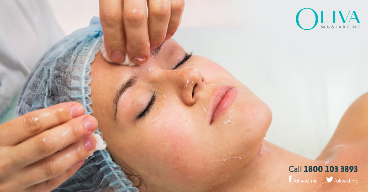 chemical peel treatment