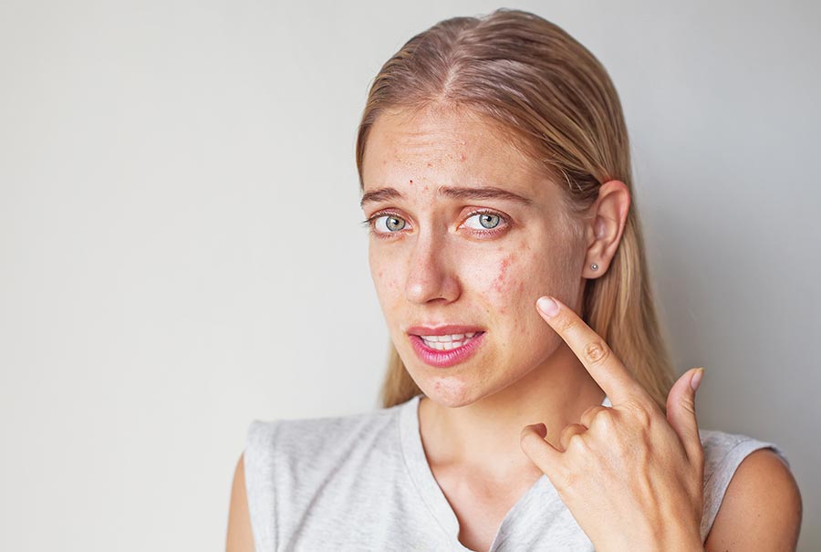 Cystic Acne On Face - Treatment Procedure And Cost