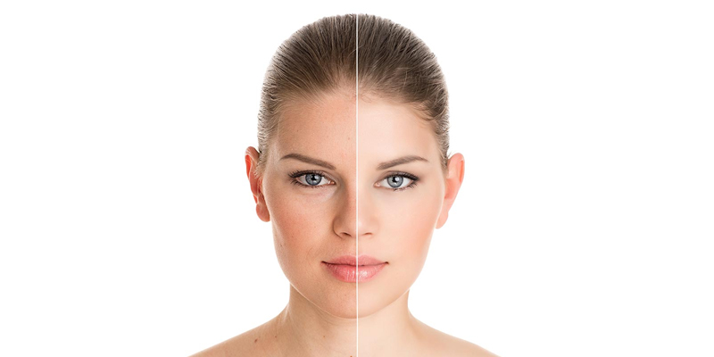 how to remove pigmentation from face