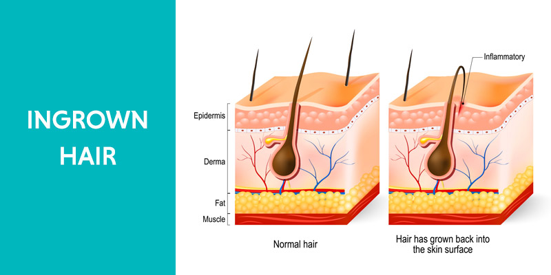 ingrown hair removal