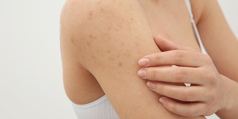 keratosis pilaris