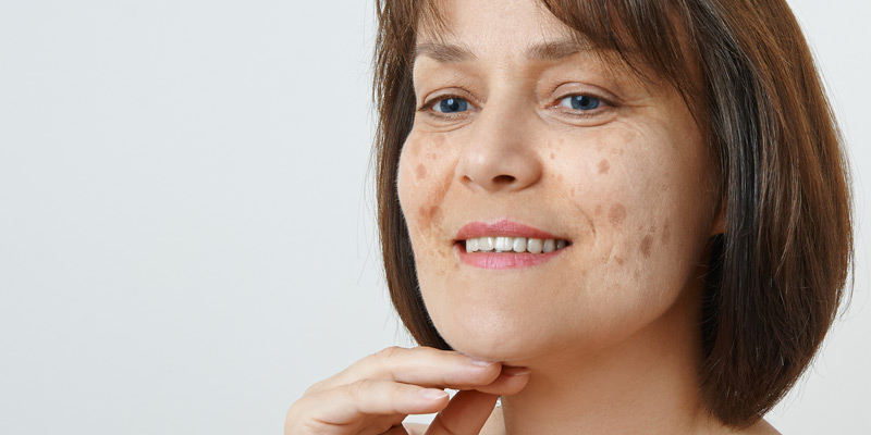How To Remove Age Spots: Treatments & Cost
