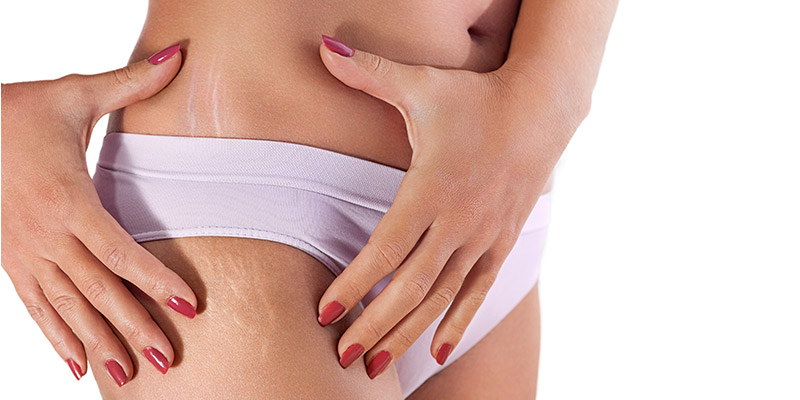 klient montering Sædvanlig How To Remove Stretch Marks On Buttocks, Thighs & Hips?