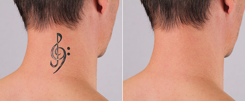 VCare Aesthetics Now a professional can fade or remove tattoos completely by using the latest technology PicoSure VCareAesthetics Picosure TattooRemoval TattooRemoval EraseTattoo Facebook #6 VCare Aesthetics Now a professional can fade or remove tattoos completely by using the latest technology PicoSure VCareAesthetics Picosure TattooRemoval TattooRemoval EraseTattoo Facebook