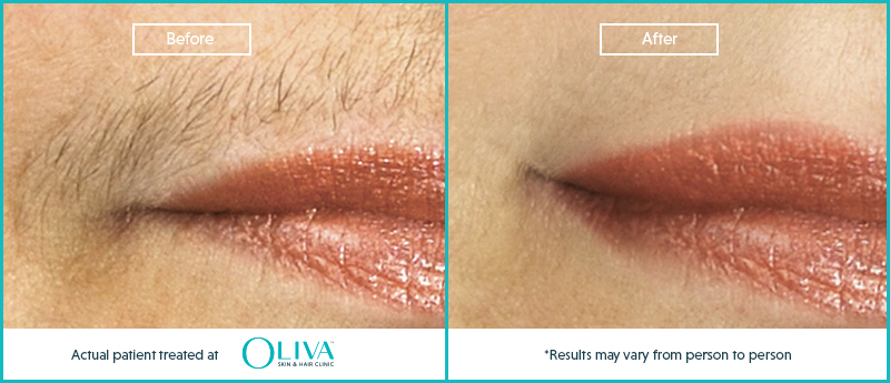 upper lip hair removal before and after