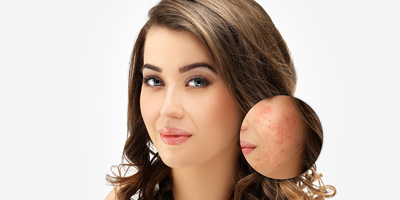 acne scar treatment in himayatnagar