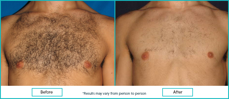 laser chest hair removal before and after results