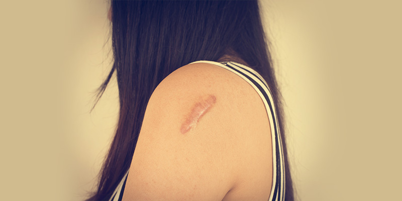 Keloid Scars: Meaning, Treatment And Cost