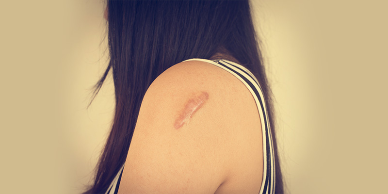 keloid scar