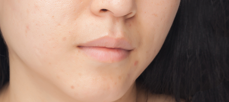 white acne scars on face