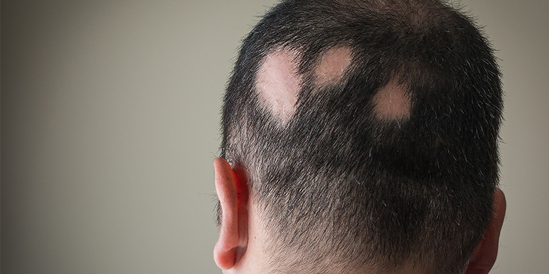 alopecia areata treatment