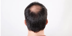 androgenetic alopecia