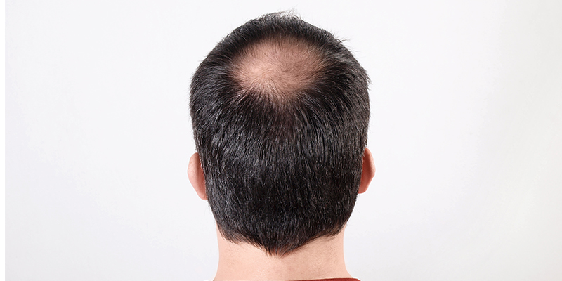 Male Hair Loss Male Pattern Baldness  PRP Hair Treatment NYC