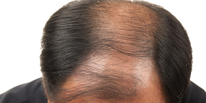 Sweat And Hair Loss How Does Sweating Cause Hair Loss