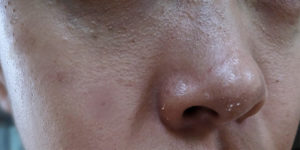 RF Microneedling - Treatment Procedure, Cost And Results