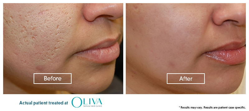 Chemical Peel For Acne Scars Cost Benefits Procedure Results 