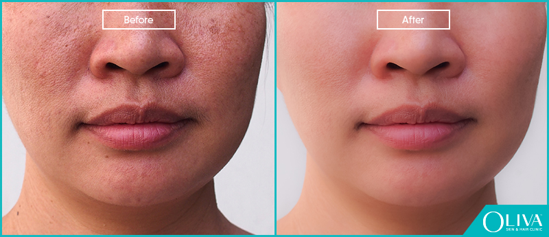 Skin whitening sales laser treatment cost