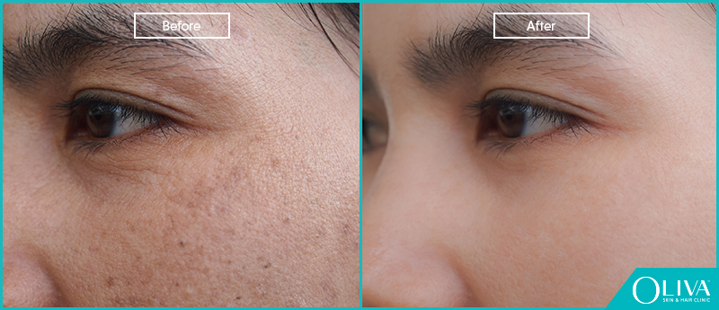 skin rejuvenation before after