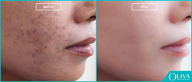 Laser Treatment For Dark Spots On Face TMBI