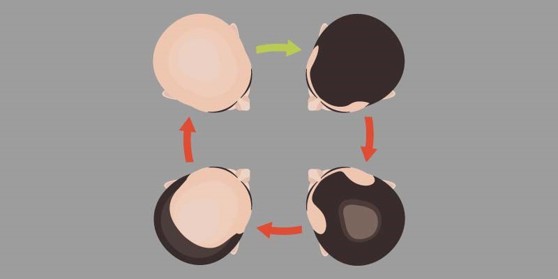 Male Pattern Baldness Symptoms