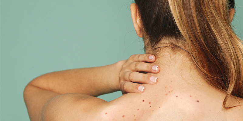 Black Spots On Back Neck Shoulders Causes And Treatment