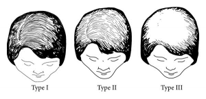 1. Thinning of the hair in the crown area