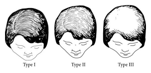 Female Pattern Baldness Signs Causes And Treatments