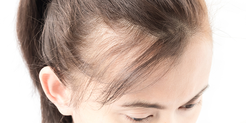 lupus hair loss