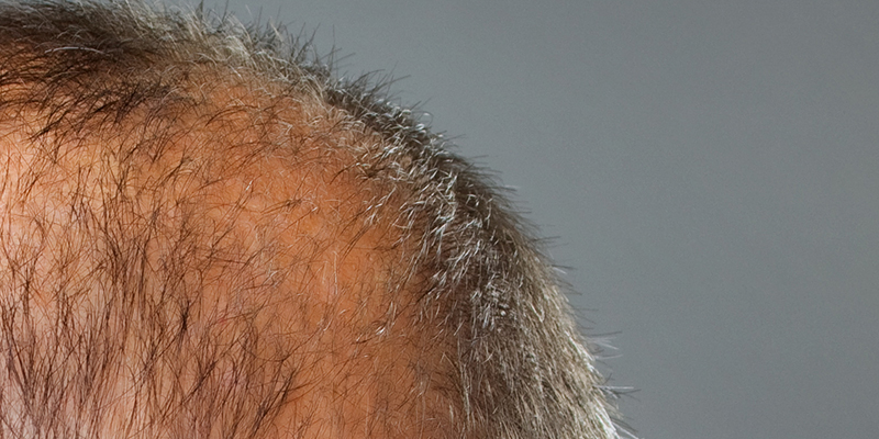 scarring alopecia