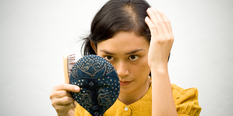 female pattern baldness