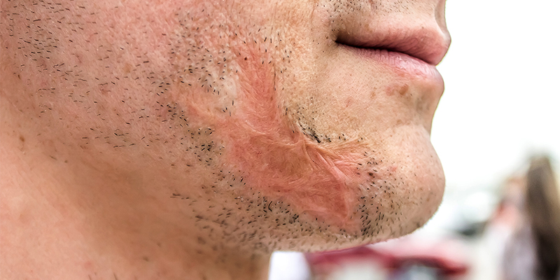 Accident Scars On Face: Treatment Procedures And Cost
