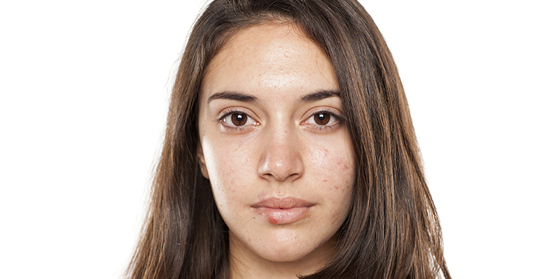 Does Celsius Cause Acne Breakouts?  