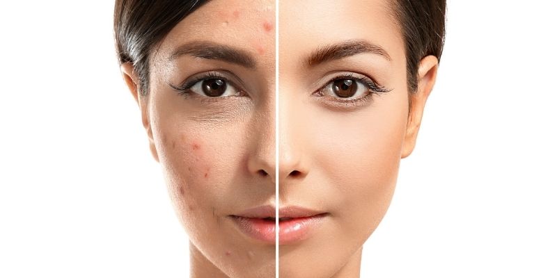 What Is Actinic Keratosis And How To Treat Them