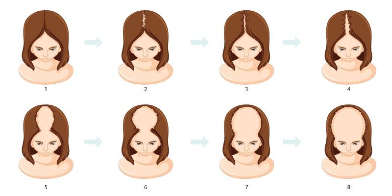 female pattern baldness infographic