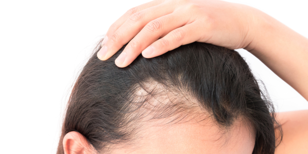 Hair loss most common in summer fall