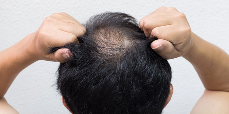 types of alopecia