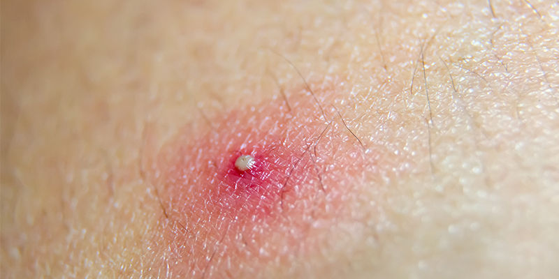 how to get rid of pustules