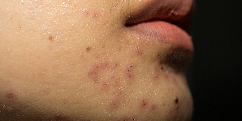 polycystic ovarian syndrome acne