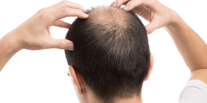 regrow lost hair in male