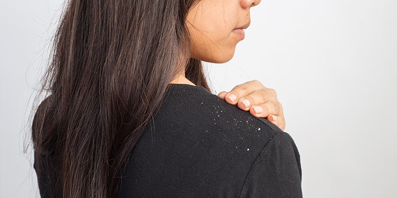 dandruff hair loss