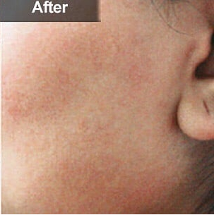 Before and After