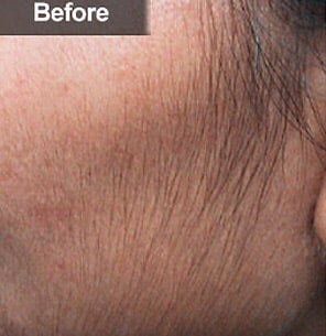 Before and After