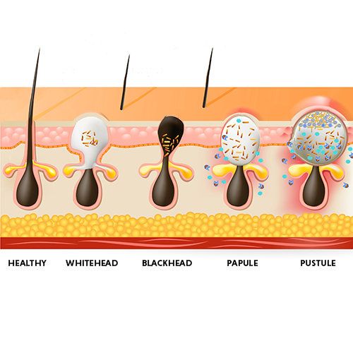 types of acne/pimples